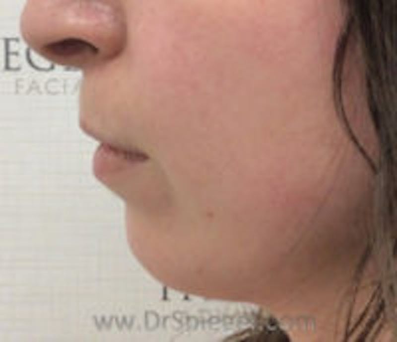 Chin Filler Before & After Gallery - Patient 149700 - Image 3