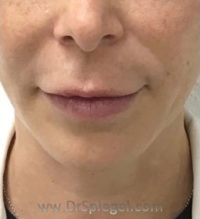 Chin Filler Before & After Gallery - Patient 175865 - Image 2