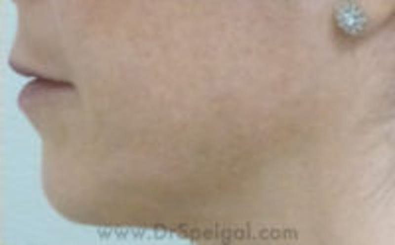 Chin Filler Before & After Gallery - Patient 175865 - Image 3