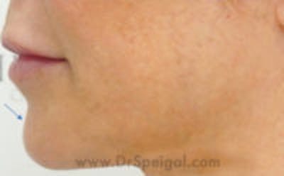 Chin Filler Before & After Gallery - Patient 175865 - Image 4