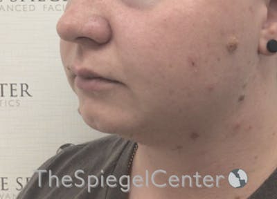 Chin Filler Before & After Gallery - Patient 107330 - Image 1
