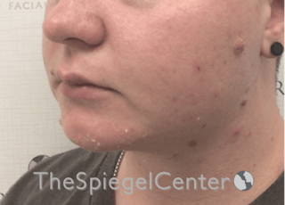 Chin Filler Before & After Gallery - Patient 107330 - Image 2