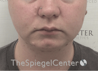 Chin Filler Before & After Gallery - Patient 107330 - Image 3