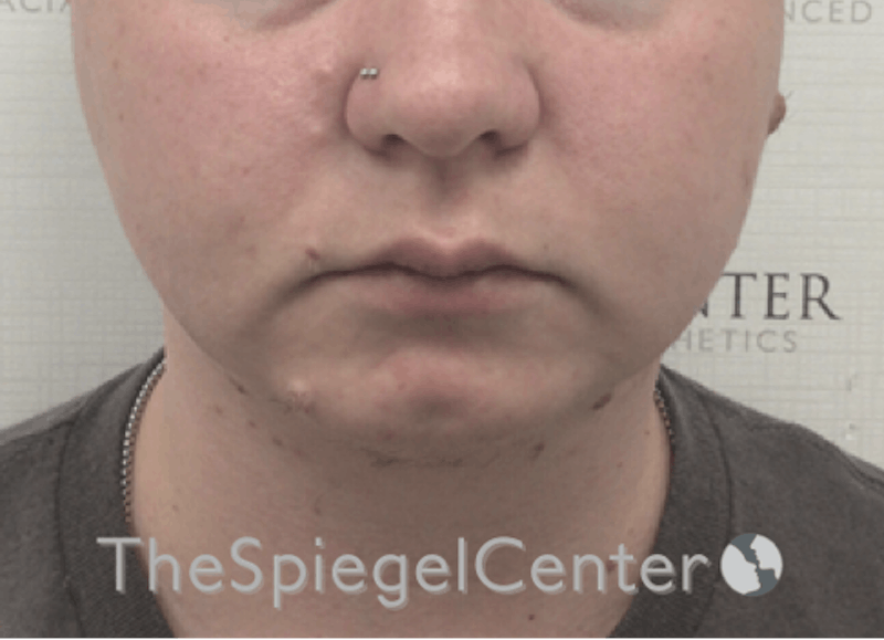 Chin Filler Before & After Gallery - Patient 107330 - Image 3