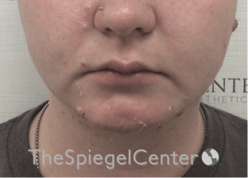 Chin Filler Before & After Gallery - Patient 107330 - Image 4