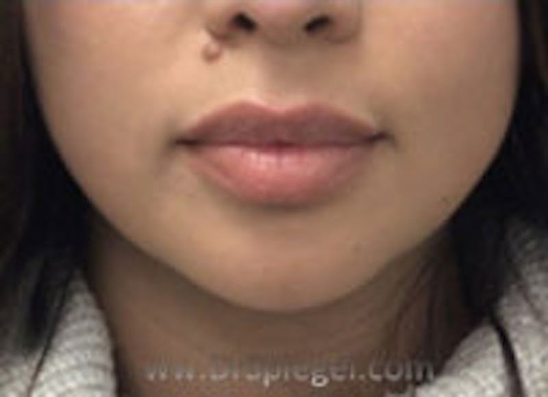 Chin Filler Before & After Gallery - Patient 253358 - Image 1