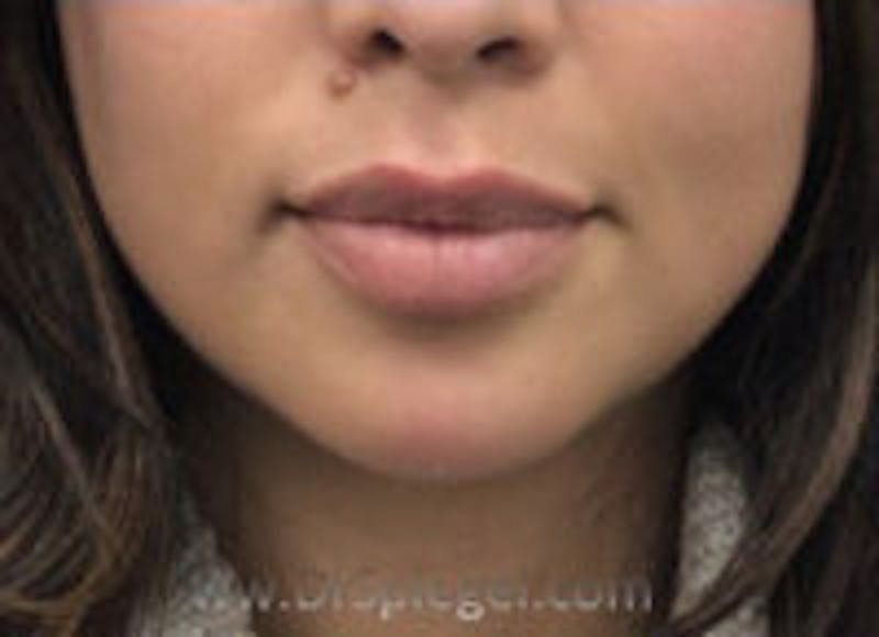 Chin Filler Before & After Gallery - Patient 253358 - Image 2