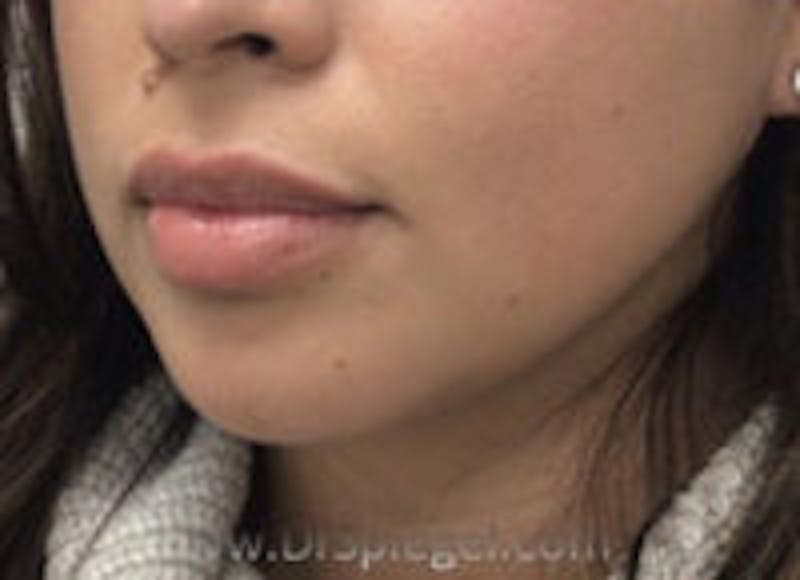 Chin Filler Before & After Gallery - Patient 253358 - Image 3