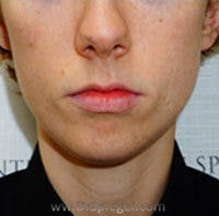 Chin Filler Before & After Gallery - Patient 392750 - Image 1