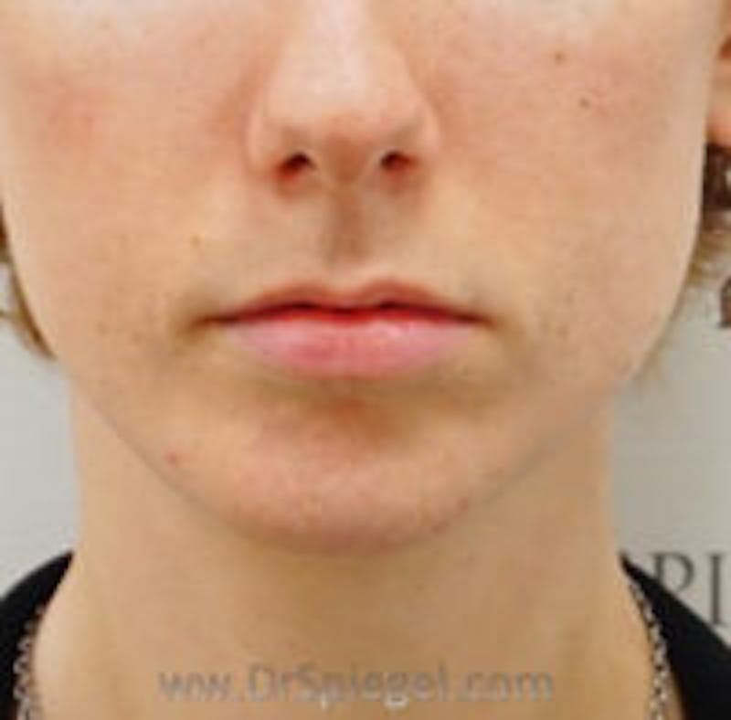 Chin Filler Before & After Gallery - Patient 392750 - Image 2