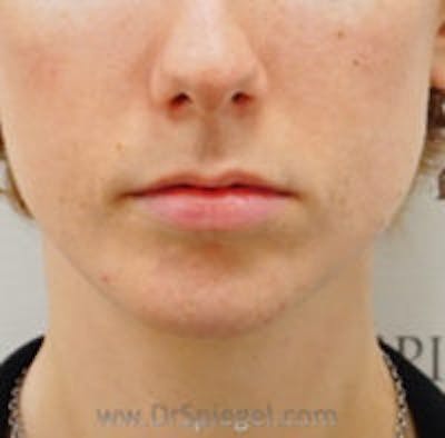 Chin Filler Before & After Gallery - Patient 392750 - Image 2