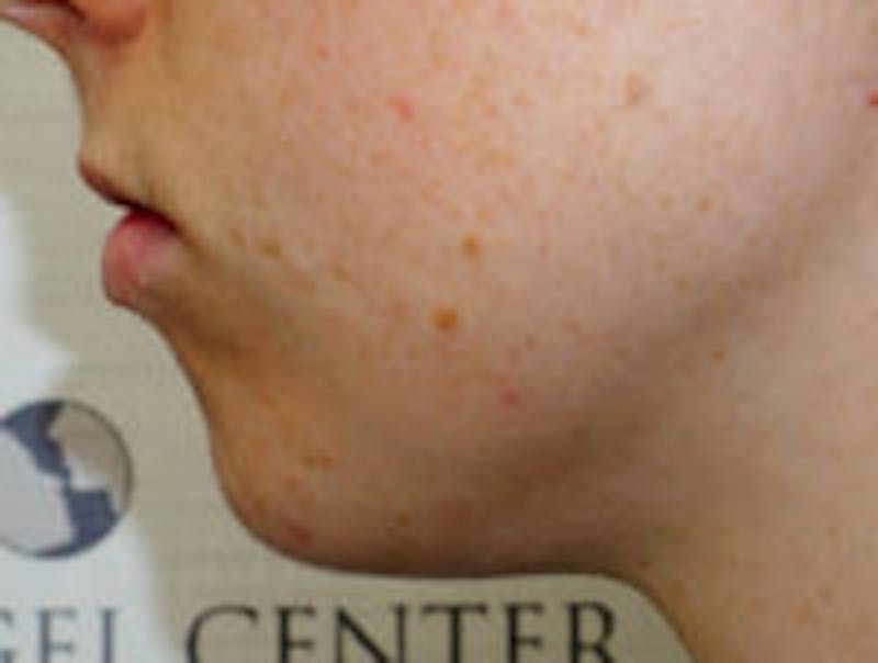 Chin Filler Before & After Gallery - Patient 392750 - Image 3