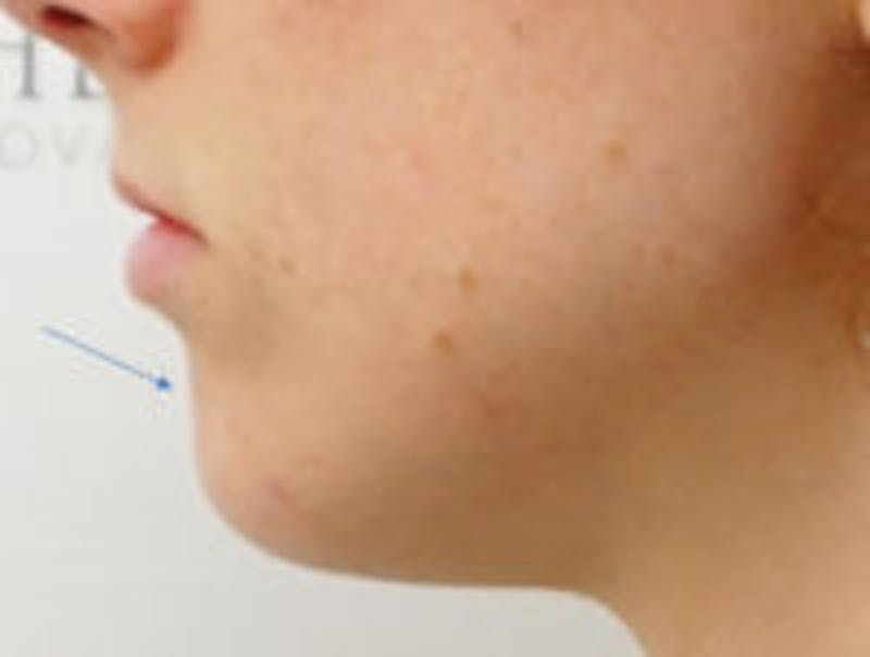 Chin Filler Before & After Gallery - Patient 392750 - Image 4