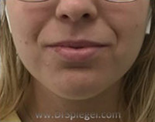 Chin Filler Before & After Gallery - Patient 114419 - Image 1