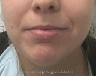 Chin Filler Before & After Gallery - Patient 114419 - Image 2