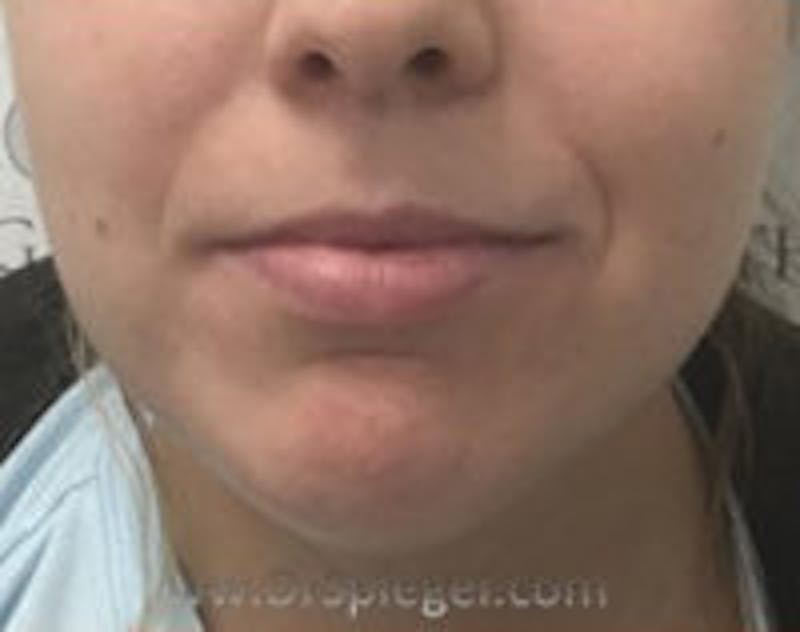 Chin Filler Before & After Gallery - Patient 114419 - Image 2