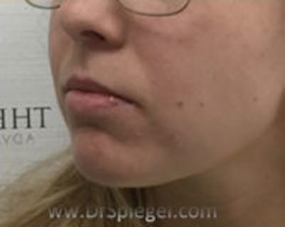 Chin Filler Before & After Gallery - Patient 114419 - Image 3