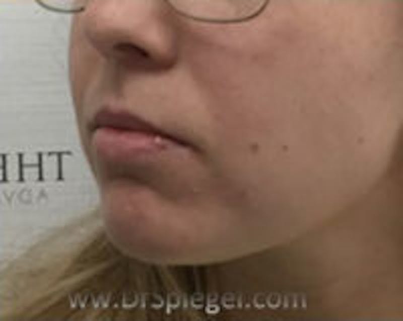 Chin Filler Before & After Gallery - Patient 114419 - Image 3