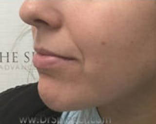 Chin Filler Before & After Gallery - Patient 114419 - Image 4