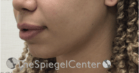 Chin Filler Before & After Gallery - Patient 578146 - Image 3