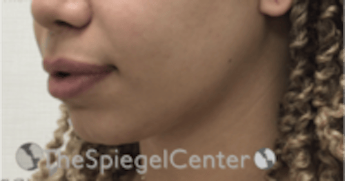 Chin Filler Before & After Gallery - Patient 578146 - Image 3