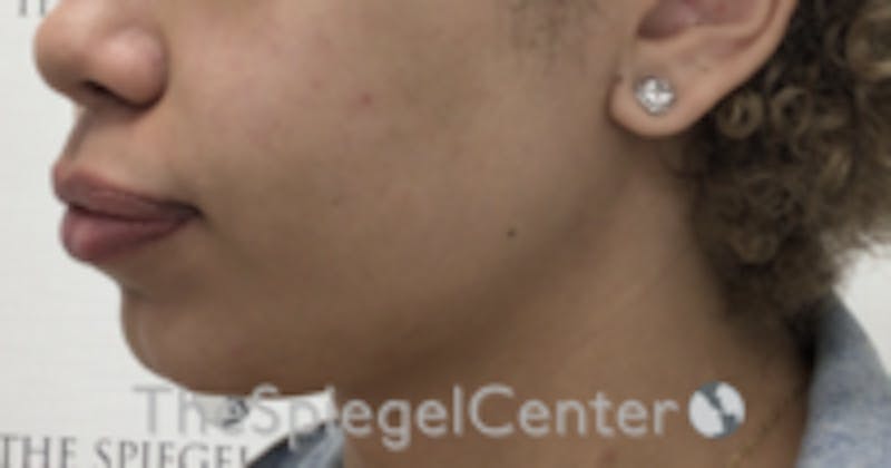 Chin Filler Before & After Gallery - Patient 578146 - Image 4