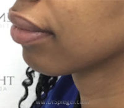 Chin Filler Before & After Gallery - Patient 361338 - Image 3