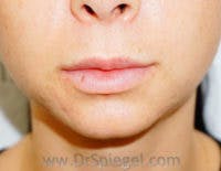 Chin Filler Before & After Gallery - Patient 397331 - Image 1