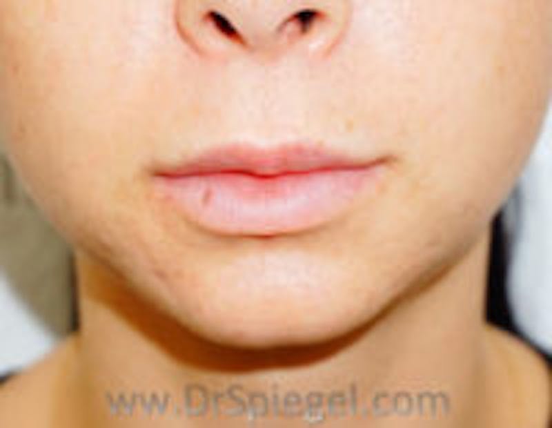 Chin Filler Before & After Gallery - Patient 397331 - Image 1