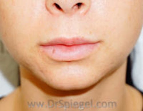 Chin Filler Before & After Gallery - Patient 397331 - Image 1