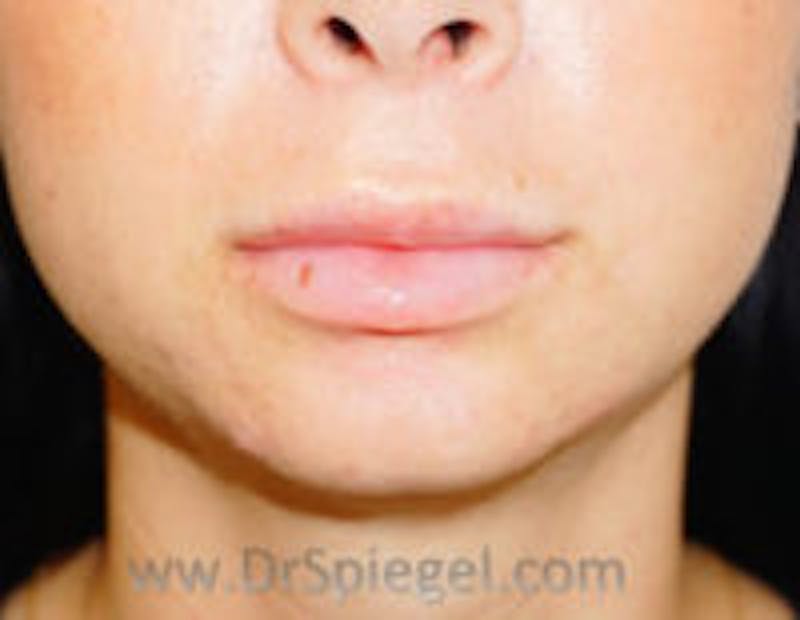 Chin Filler Before & After Gallery - Patient 397331 - Image 2