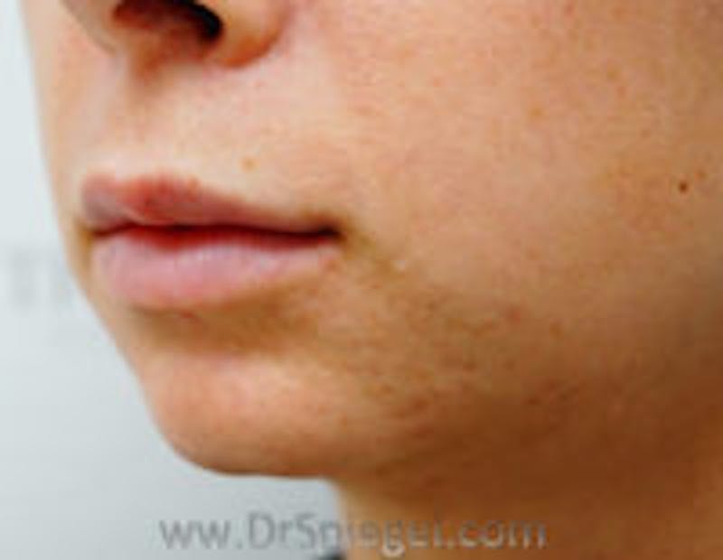Chin Filler Before & After Gallery - Patient 397331 - Image 3
