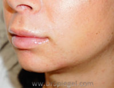 Chin Filler Before & After Gallery - Patient 397331 - Image 4