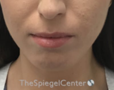 Chin Filler Before & After Gallery - Patient 186113 - Image 1