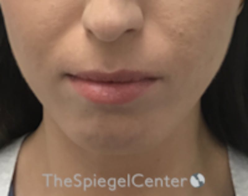 Chin Filler Before & After Gallery - Patient 186113 - Image 1