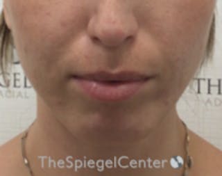 Chin Filler Before & After Gallery - Patient 186113 - Image 2