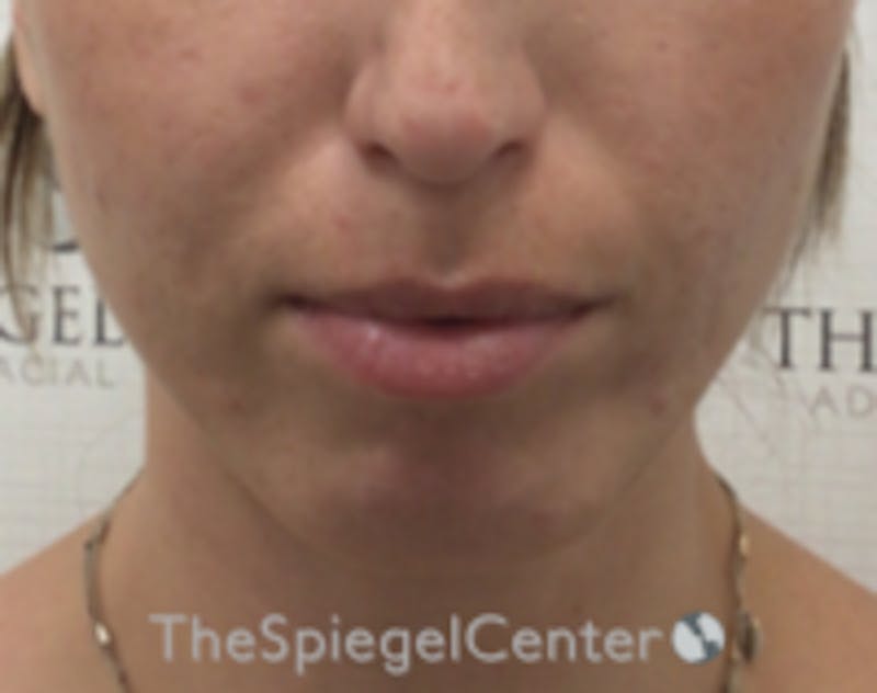 Chin Filler Before & After Gallery - Patient 186113 - Image 2
