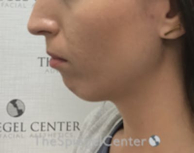 Chin Filler Before & After Gallery - Patient 186113 - Image 3