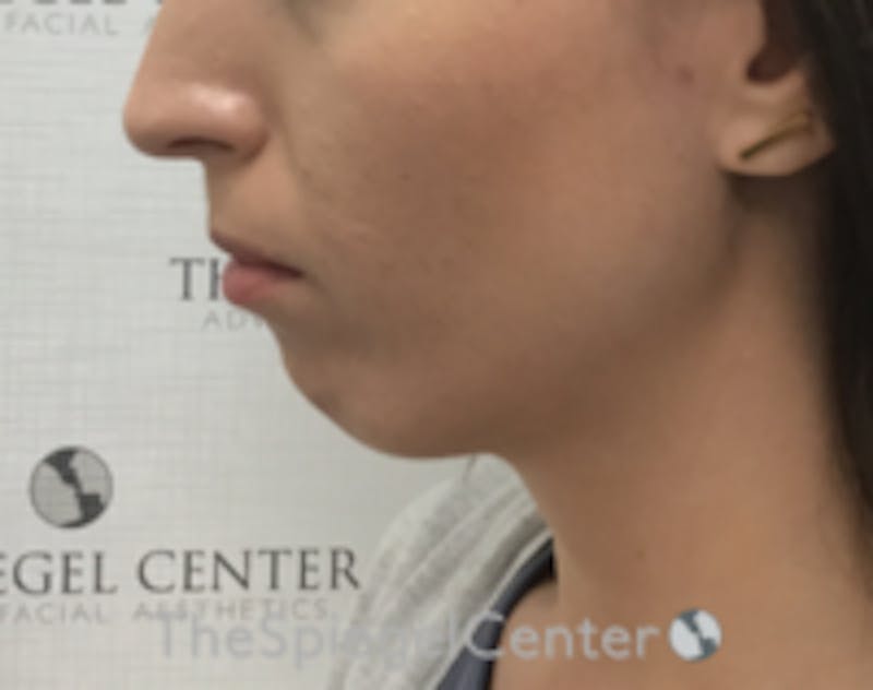 Chin Filler Before & After Gallery - Patient 186113 - Image 3