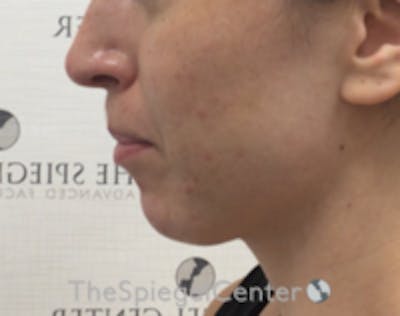 Chin Filler Before & After Gallery - Patient 186113 - Image 4