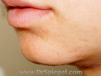 Chin Filler Before & After Gallery - Patient 290747 - Image 1
