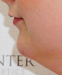 Chin Filler Before & After Gallery - Patient 182698 - Image 1