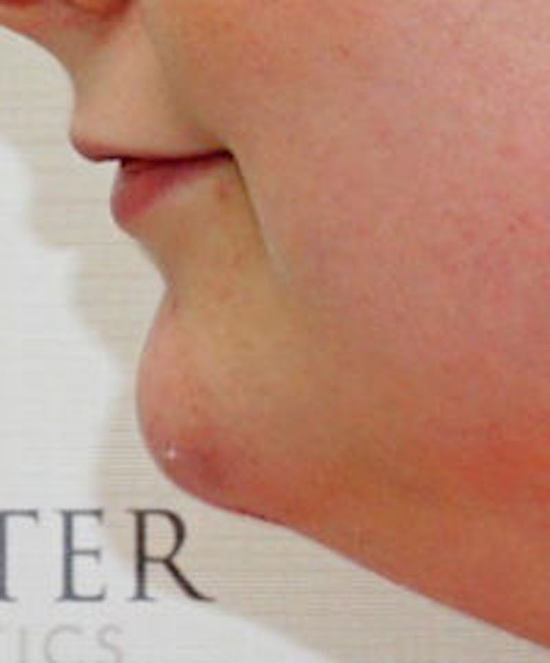 Chin Filler Before & After Gallery - Patient 182698 - Image 2