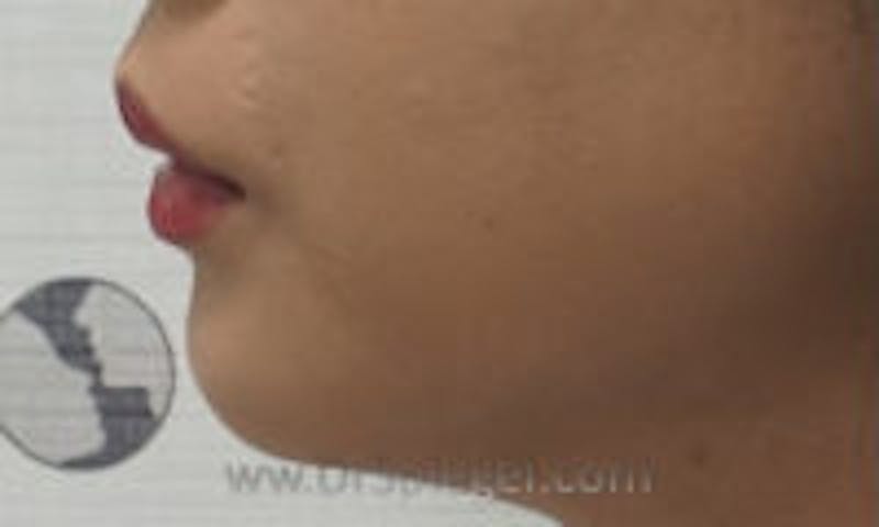 Chin Filler Before & After Gallery - Patient 200737 - Image 1