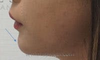 Chin Fillers Before & After Gallery - Patient 325666 - Image 2