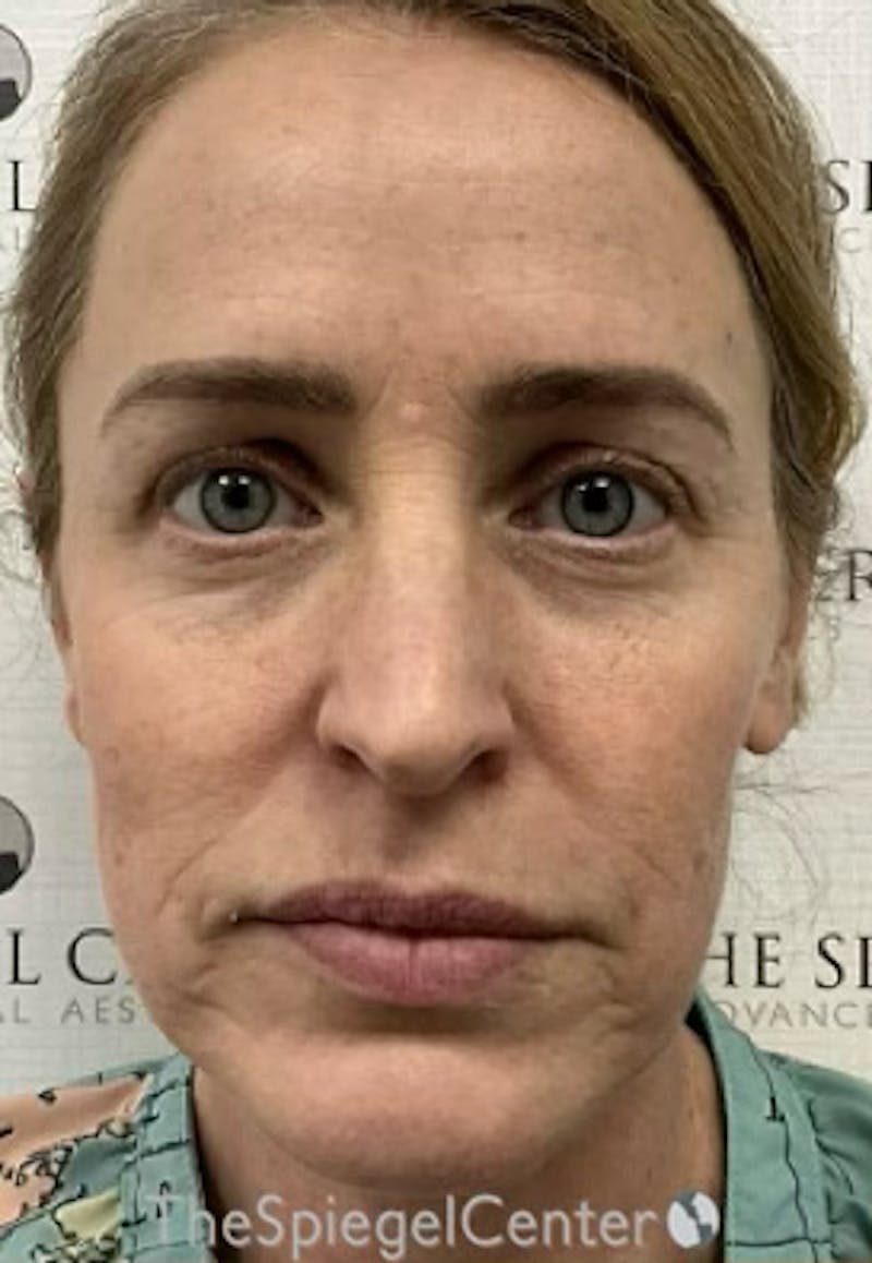 CO2 Laser Before & After Gallery - Patient 221071 - Image 1