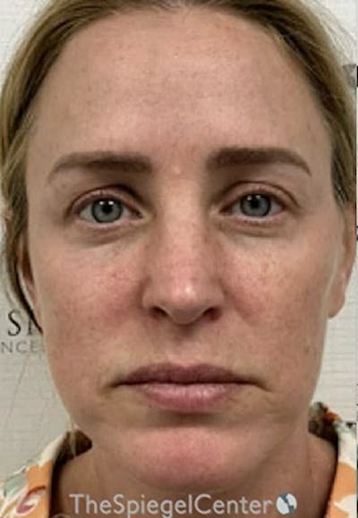 CO2 Laser Before & After Gallery - Patient 221071 - Image 2