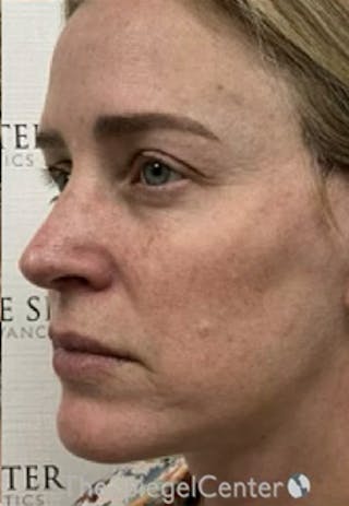 CO2 Laser Before & After Gallery - Patient 221071 - Image 4