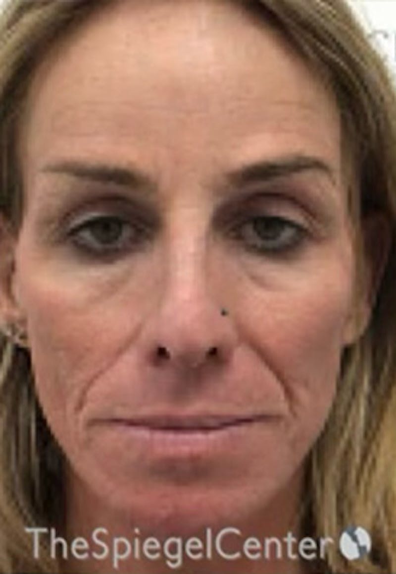 CO2 Laser Before & After Gallery - Patient 415328 - Image 1