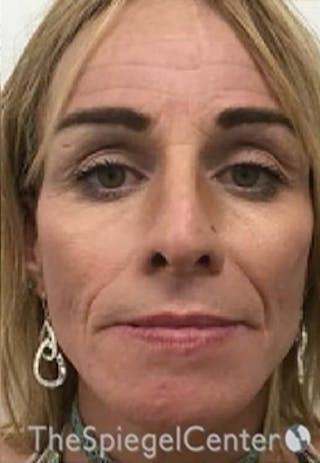 CO2 Laser Before & After Gallery - Patient 415328 - Image 2